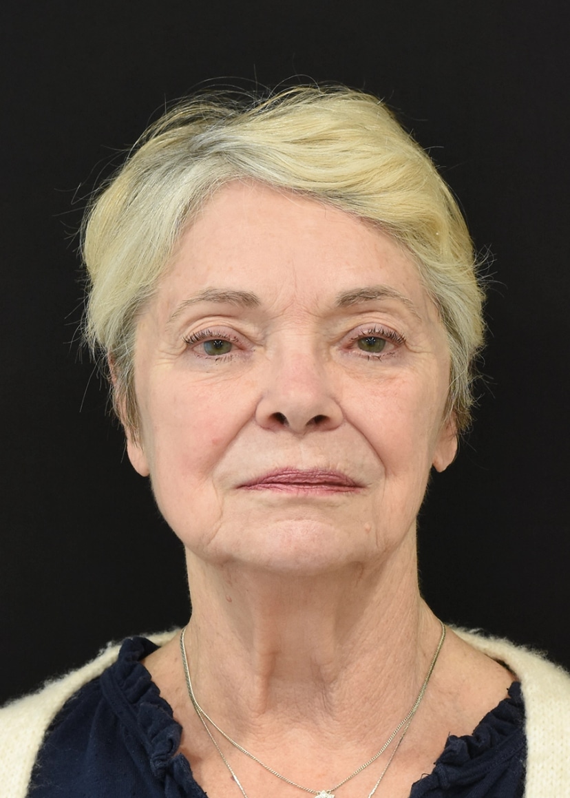 Extended Deep Plane Facelift Patient 10 Set 1 Before