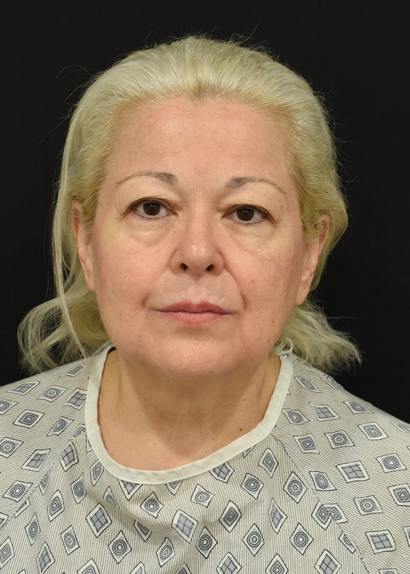 Neck Lift Patient 23 Set 1 Before